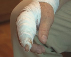 NOROC CU TELEVIZIUNEA... BĂRBATUL CU AŞCHIA ÎN DEGET, OPERAT DE URGENŢĂ