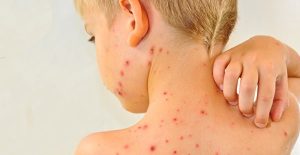 ALERTĂ DE RUJEOLĂ. PESTE 1500 DE COPII BUZOIENI NU SUNT VACCINAŢI