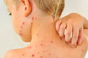ALERTĂ DE RUJEOLĂ ŞI LA BUZĂU. EPIDEMIOLOGII TRAG SEMNALE DE ALARMĂ