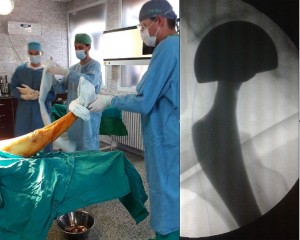 operatie proteza sold video)