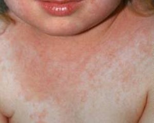 MEDICII EPIDEMIOLOGI, ÎN ALERTĂ. CAZUL DE SCARLATINĂ, CONFIRMAT