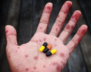 SUSPICIUNE DE SCARLATINĂ LA BUZĂU. VIZAT, UN COPIL DE GRĂDINIŢĂ