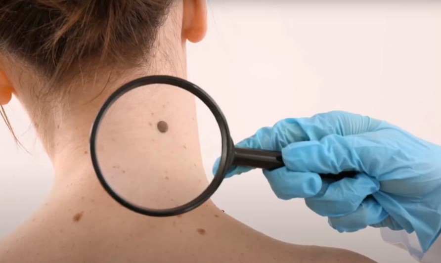 Pericol pentru sănătate. Neplăcerile aduse de arsurile solare, în perioada verii