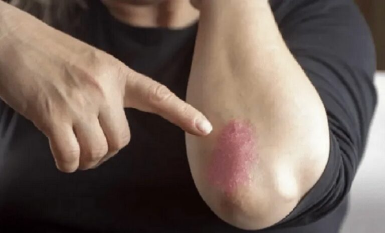 Afectează pielea, dar și... psihicul. Psoriazis, afecțiune cu incidență mare în rândul buzoienilor