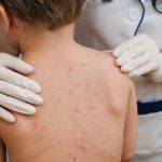 Adulții, mai expuși decât copiii. Tot mai multe cazuri de varicelă în județul Buzău
