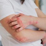 Schimbarea vremii, pericol pentru piele. Avertismentul dermatologilor, la trecerea de la vară la toamnă